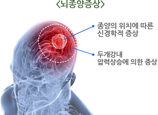 뇌종양증상- 종양의 위치에 따른 신경결손 증상, 두개강내 압력상승에 의한 증상
